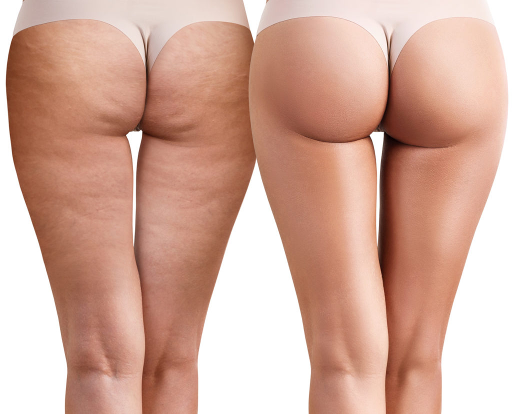 Tak Hanya Lemak, Selulit Juga Dipicu Hormon, Penuaan, Dan Perubahan Berat Badan