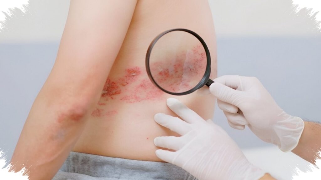 Nyeri Herpes Zoster Bisa Bertahan Setelah Ruam Sembuh, Kelompok Dengan Penyakit Kronis Paling Rentan