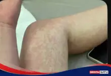 Saat Campak Mengintai, Tiga Hal Ini Perlu Langsung Anda Cek Jika Pernah Terpapar
