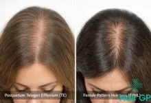 Baby Hair yang Sering Terlewat, Tanda Tubuh Mulai Pulih Setelah Melahirkan