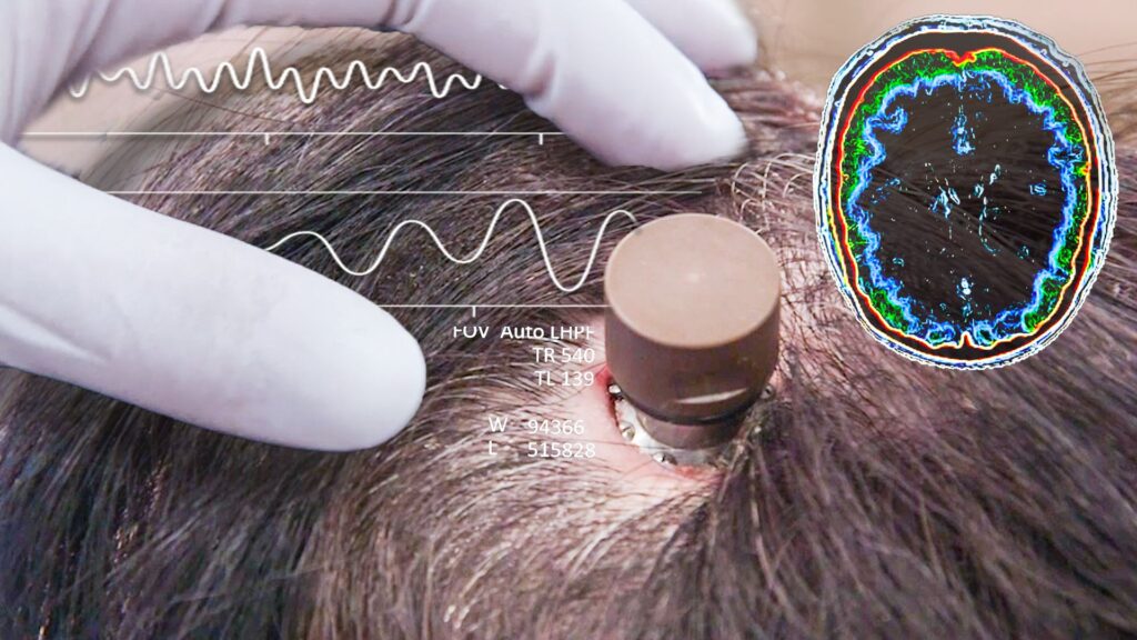 Samsung Masuk ke Chip Implan Otak Neuralink, Proyek O1 Makin Dekat Nyata