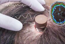 Samsung Masuk ke Chip Implan Otak Neuralink, Proyek O1 Makin Dekat Nyata