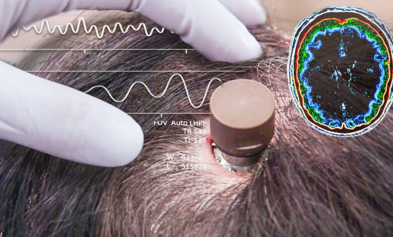 Samsung Masuk ke Chip Implan Otak Neuralink, Proyek O1 Makin Dekat Nyata