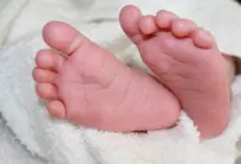 Gumoh Pada Bayi Tidak Selalu Berbahaya, Ini Tanda yang Harus Diwaspadai